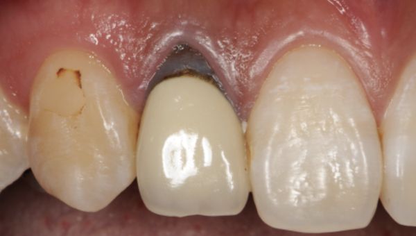 歯周形成外科と審美修復治療 治療前