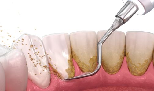 歯垢・歯石の除去 イメージ