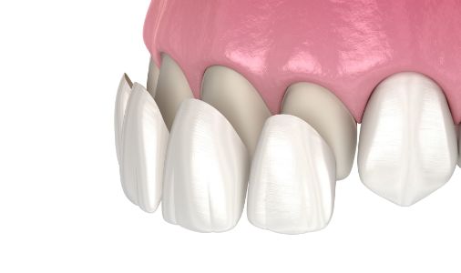 歯科治療 イメージ