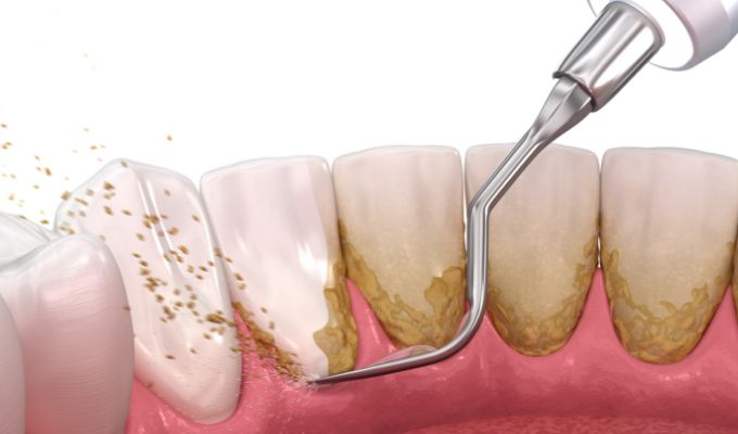 歯石の除去 イメージ